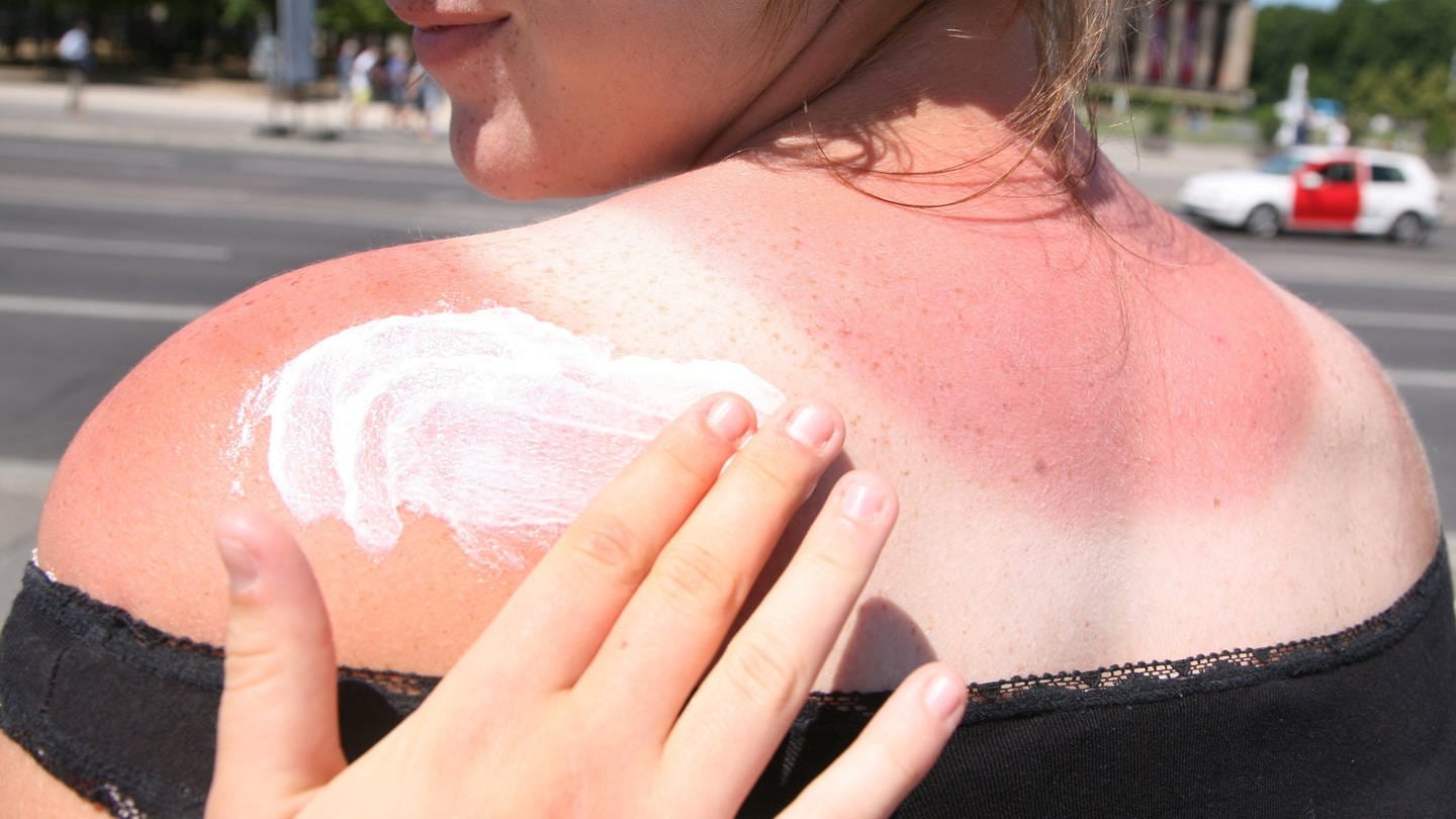 Eine Frau mit Sonnenbrand bekommt den Rücken mit Sonnencreme eingecremt. In Deutschland ist die Anzahl der Todesfälle durch Hautkrebs in den letzten 20 Jahren stark angestiegen.