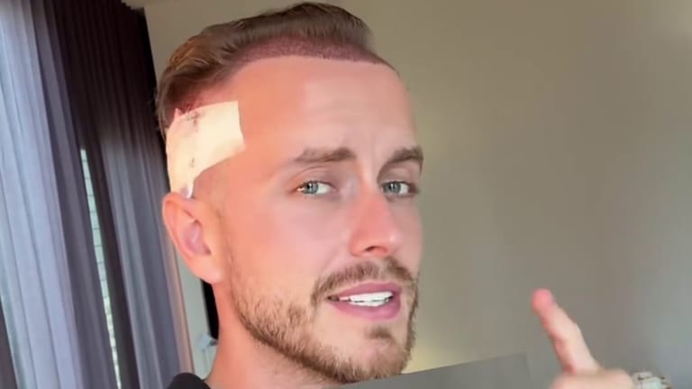 Julian Claßen a.k.a. Julienco hatte krasse Geheimratsecken. Deshalb hat er eine Haartransplantation machen lassen.